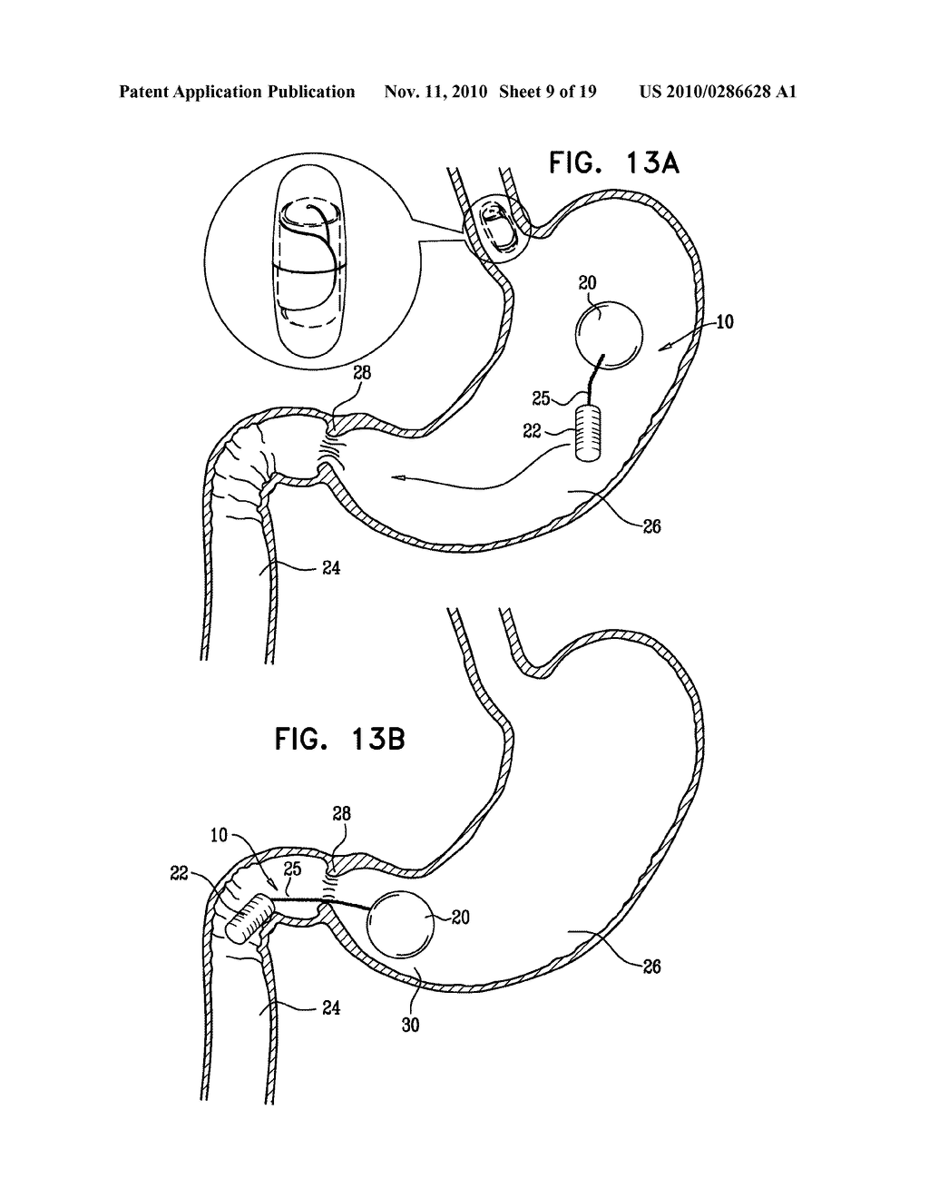 GASTRIC ANCHOR - diagram, schematic, and image 10