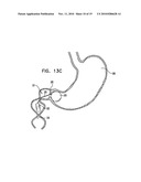 GASTRIC ANCHOR diagram and image