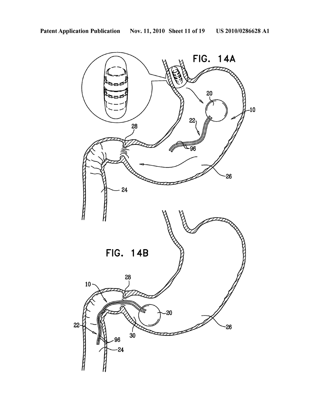 GASTRIC ANCHOR - diagram, schematic, and image 12