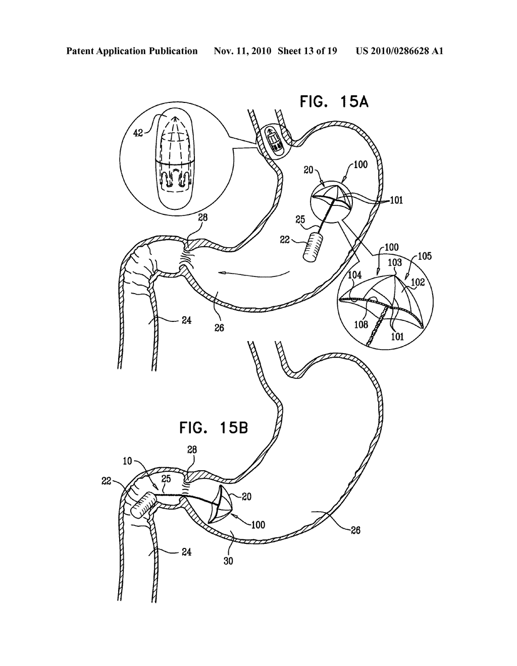 GASTRIC ANCHOR - diagram, schematic, and image 14