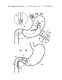 GASTRIC ANCHOR diagram and image