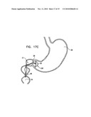 GASTRIC ANCHOR diagram and image