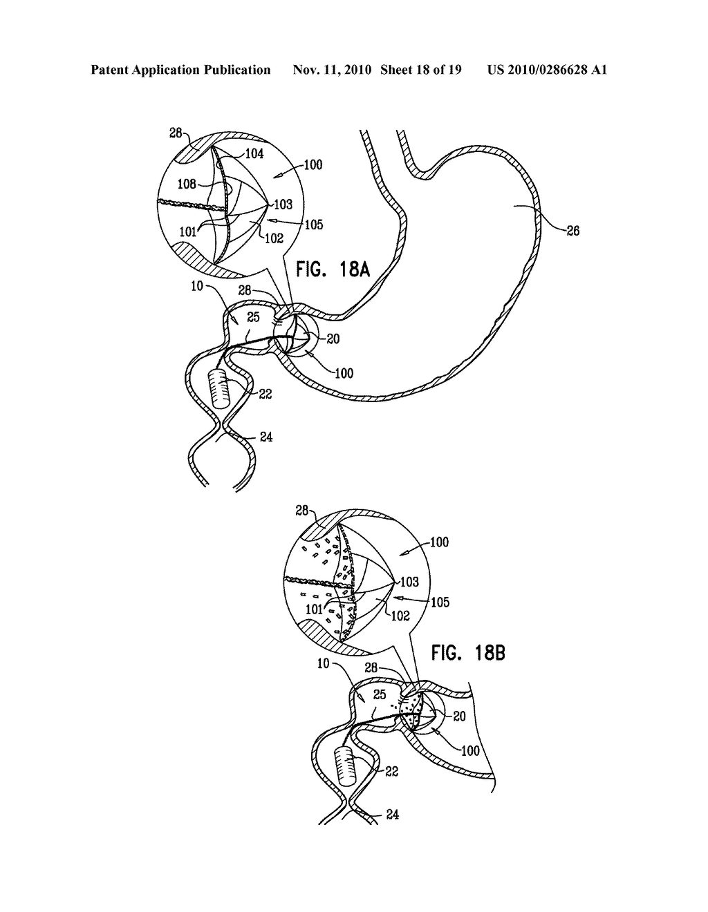 GASTRIC ANCHOR - diagram, schematic, and image 19