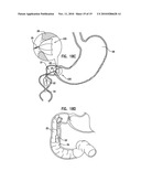 GASTRIC ANCHOR diagram and image