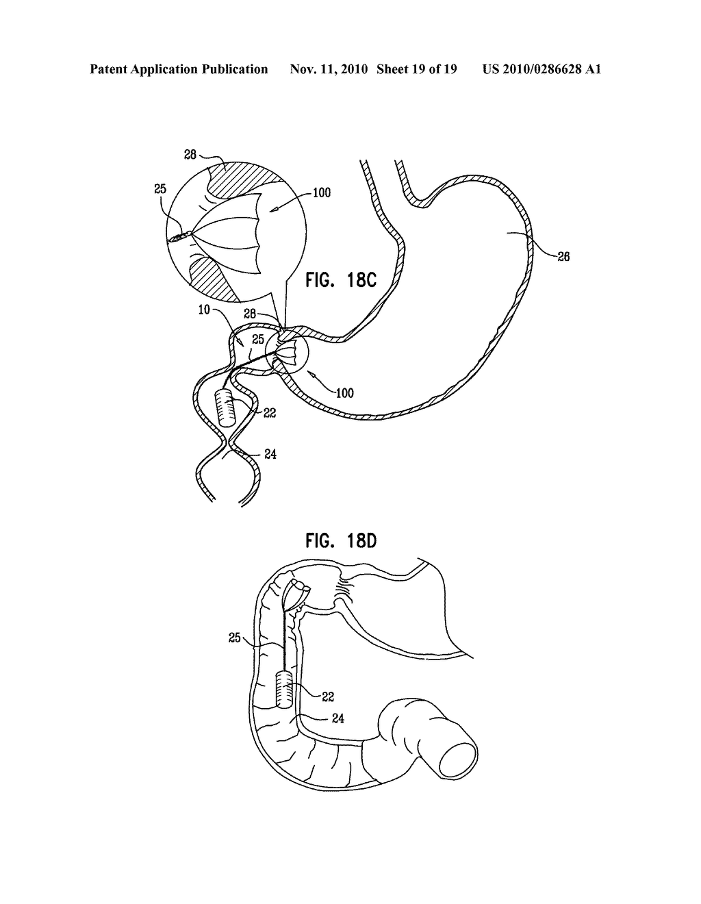 GASTRIC ANCHOR - diagram, schematic, and image 20
