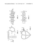 CRYOSURGICAL CATHETER diagram and image