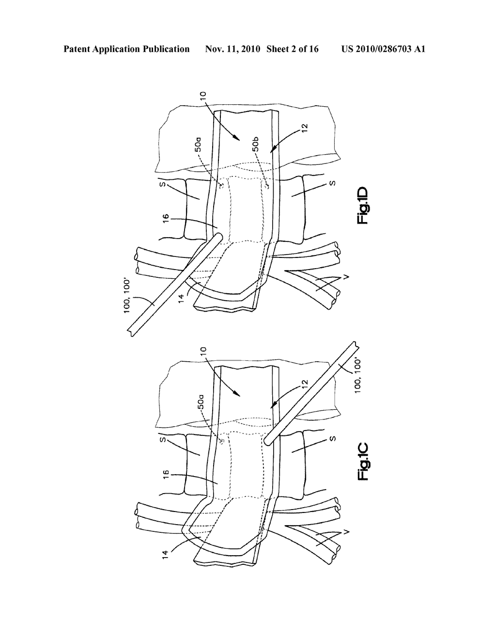  TACK OR DRIVE SCREW FOR SECURING A PROSTHESIS TO BONE AND ASSOCIATED INSTRUMENTATION AND METHOD - diagram, schematic, and image 03