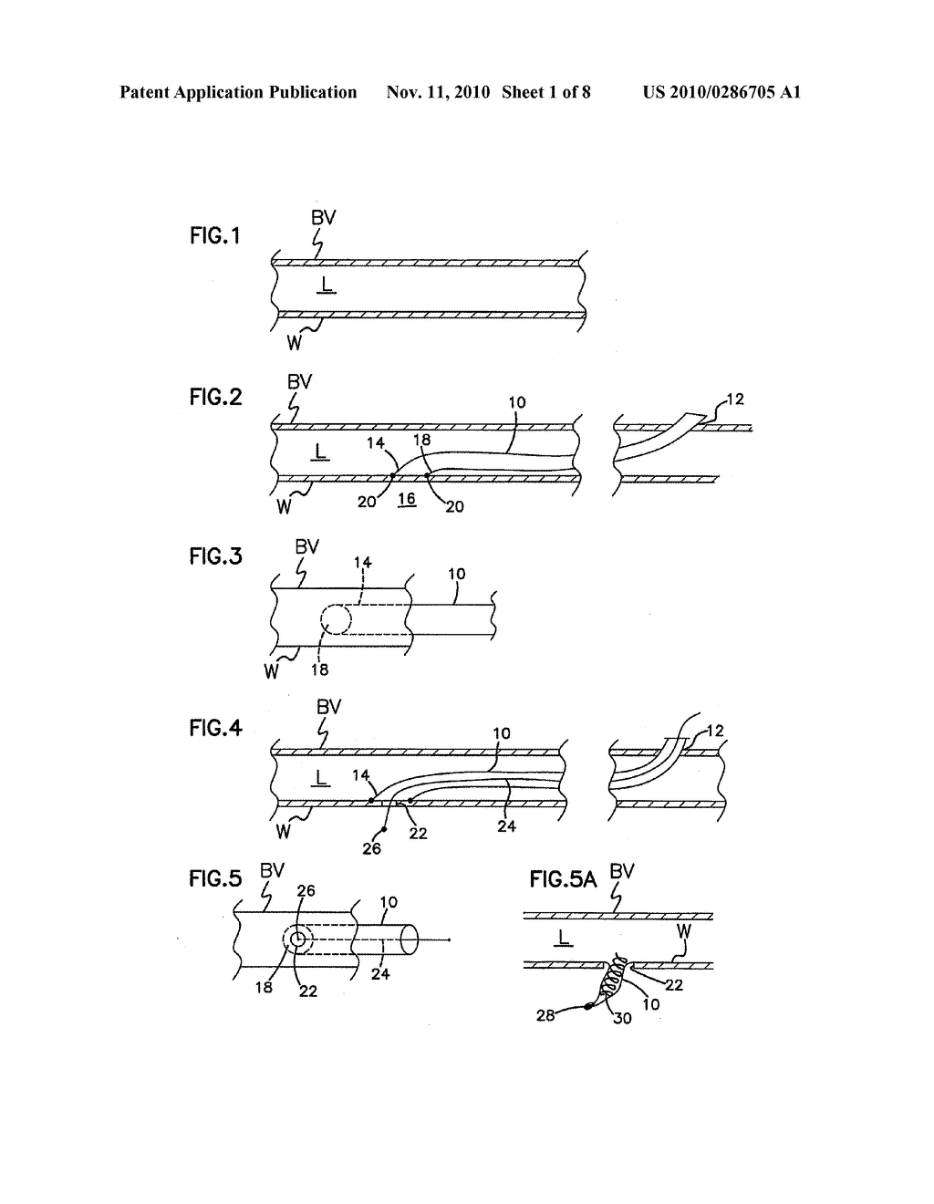 VASCULAR ACCESS TO EXTRA-VASCULAR SPACE - diagram, schematic, and image 02