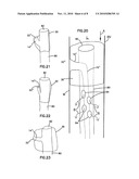 VASCULAR ACCESS TO EXTRA-VASCULAR SPACE diagram and image