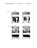 CLINICAL DIAGNOSIS OF HEPATIC FIBROSIS USING A NOVEL PANEL OF LOW ABUNDANT HUMAN PLASMA PROTEIN BIOMARKERS diagram and image