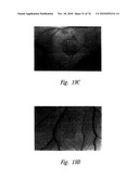 ANTI-ANGIOGENIC COMPOSITIONS AND METHODS OF USE diagram and image