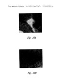 ANTI-ANGIOGENIC COMPOSITIONS AND METHODS OF USE diagram and image