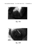 ANTI-ANGIOGENIC COMPOSITIONS AND METHODS OF USE diagram and image