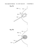 METHODS AND APPARATUS FOR PERFORMING INTERSTITIAL LASER THERAPY AND INTERSTITIAL BRACHYTHERAPY diagram and image