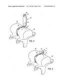 Spinal Marker System and Methods of Use diagram and image