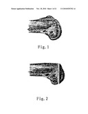 FEMORAL CONDYLE CUTTING AND SHAPING DEVICE diagram and image