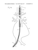 ENDOVASCULAR ROUTER DEVICE AND METHOD diagram and image