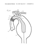 ENDOVASCULAR ROUTER DEVICE AND METHOD diagram and image