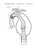 ENDOVASCULAR ROUTER DEVICE AND METHOD diagram and image