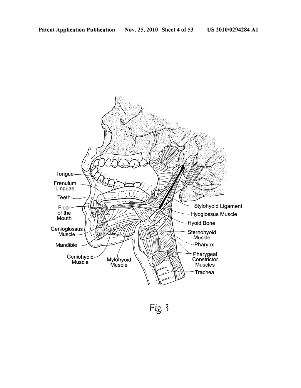 Apparatus, systems, and methods for constraining and/or supporting tissue structures along an airway - diagram, schematic, and image 05