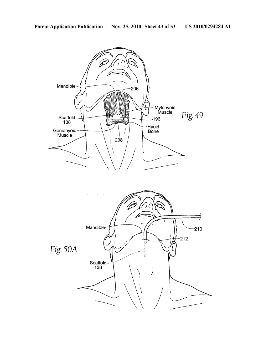 Apparatus, systems, and methods for constraining and/or supporting tissue structures along an airway - diagram, schematic, and image 44