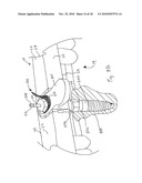 CT-based, Side-loading Surgical and Laboratory Dental Implant Guide System and Methodology of Use diagram and image