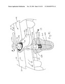 CT-based, Side-loading Surgical and Laboratory Dental Implant Guide System and Methodology of Use diagram and image