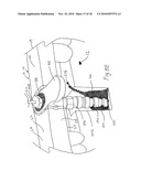 CT-based, Side-loading Surgical and Laboratory Dental Implant Guide System and Methodology of Use diagram and image