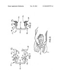 Brace for holding a patient s mouth open during dental procedures diagram and image