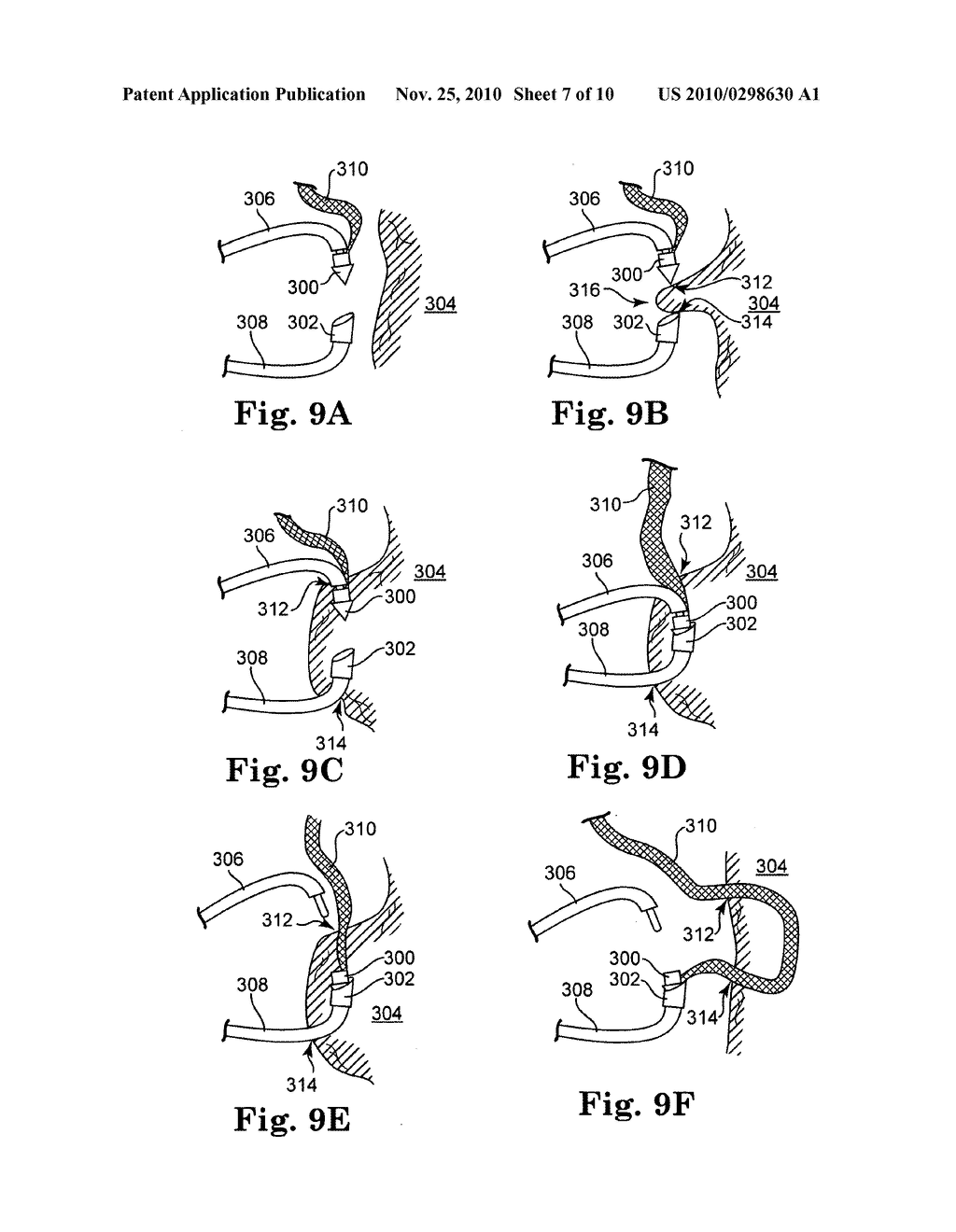 PELVIC FLOOR TREATMENTS AND RELATED TOOLS AND IMPLANTS - diagram, schematic, and image 08