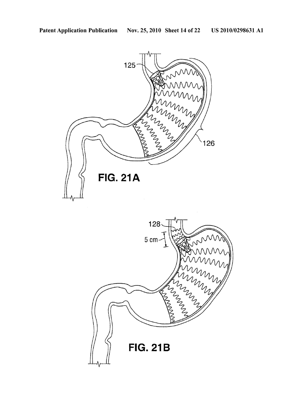 SATIATION DEVICES AND METHODS - diagram, schematic, and image 15