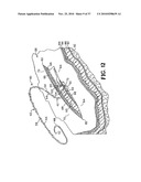 METHODS FOR USING SELF-RETAINING SUTURES IN ENDOSCOPIC PROCEDURES diagram and image