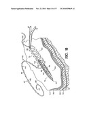 METHODS FOR USING SELF-RETAINING SUTURES IN ENDOSCOPIC PROCEDURES diagram and image