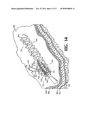 METHODS FOR USING SELF-RETAINING SUTURES IN ENDOSCOPIC PROCEDURES diagram and image