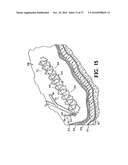 METHODS FOR USING SELF-RETAINING SUTURES IN ENDOSCOPIC PROCEDURES diagram and image