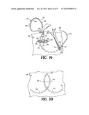 METHODS FOR USING SELF-RETAINING SUTURES IN ENDOSCOPIC PROCEDURES diagram and image