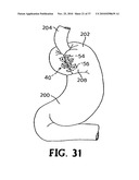 METHODS FOR USING SELF-RETAINING SUTURES IN ENDOSCOPIC PROCEDURES diagram and image