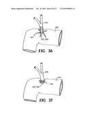METHODS FOR USING SELF-RETAINING SUTURES IN ENDOSCOPIC PROCEDURES diagram and image