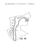 METHODS FOR USING SELF-RETAINING SUTURES IN ENDOSCOPIC PROCEDURES diagram and image