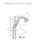 METHODS FOR USING SELF-RETAINING SUTURES IN ENDOSCOPIC PROCEDURES diagram and image