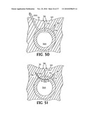 METHODS FOR USING SELF-RETAINING SUTURES IN ENDOSCOPIC PROCEDURES diagram and image