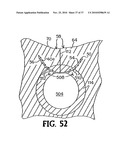 METHODS FOR USING SELF-RETAINING SUTURES IN ENDOSCOPIC PROCEDURES diagram and image