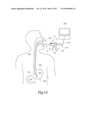 MANIPULATABLE GUIDE SYSTEM AND METHODS FOR NATURAL ORIFICE TRANSLUMENAL ENDOSCOPIC SURGERY diagram and image