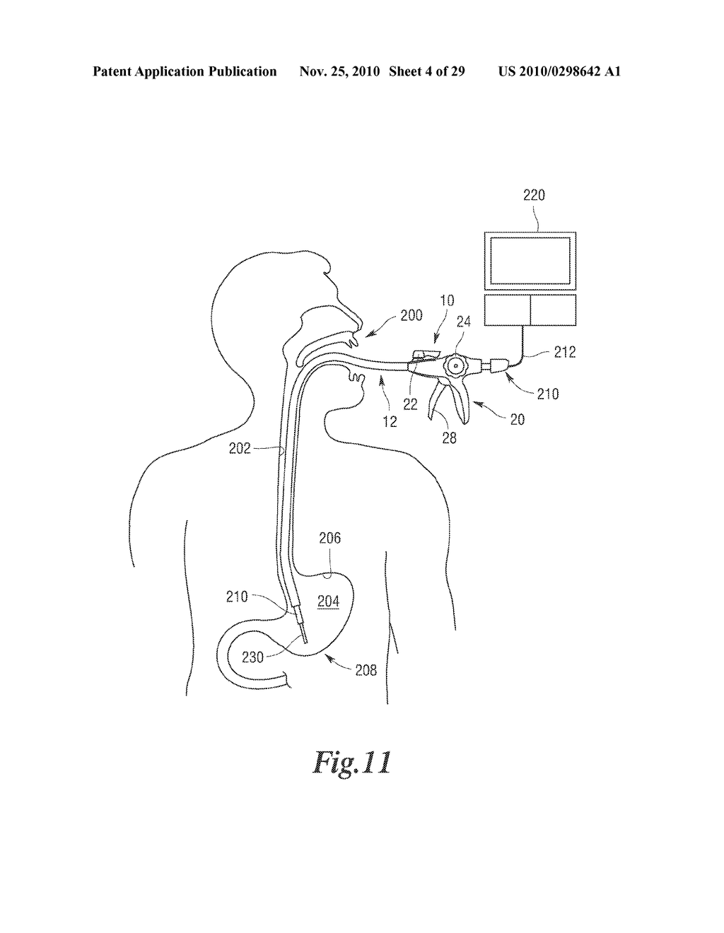 MANIPULATABLE GUIDE SYSTEM AND METHODS FOR NATURAL ORIFICE TRANSLUMENAL ENDOSCOPIC SURGERY - diagram, schematic, and image 05