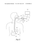 MANIPULATABLE GUIDE SYSTEM AND METHODS FOR NATURAL ORIFICE TRANSLUMENAL ENDOSCOPIC SURGERY diagram and image