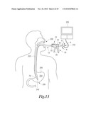 MANIPULATABLE GUIDE SYSTEM AND METHODS FOR NATURAL ORIFICE TRANSLUMENAL ENDOSCOPIC SURGERY diagram and image