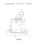 MANIPULATABLE GUIDE SYSTEM AND METHODS FOR NATURAL ORIFICE TRANSLUMENAL ENDOSCOPIC SURGERY diagram and image