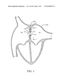 DEVICES, SYSTEMS, AND METHODS TO TREAT HEART FAILURE HAVING AN IMPROVED FLOW-CONTROL MECHANISM diagram and image