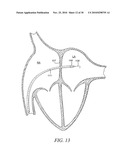 DEVICES, SYSTEMS, AND METHODS TO TREAT HEART FAILURE HAVING AN IMPROVED FLOW-CONTROL MECHANISM diagram and image