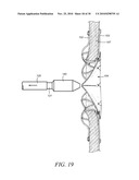 DEVICES, SYSTEMS, AND METHODS TO TREAT HEART FAILURE HAVING AN IMPROVED FLOW-CONTROL MECHANISM diagram and image